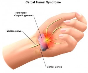ort_Carpal_Tunnel_Syndrome